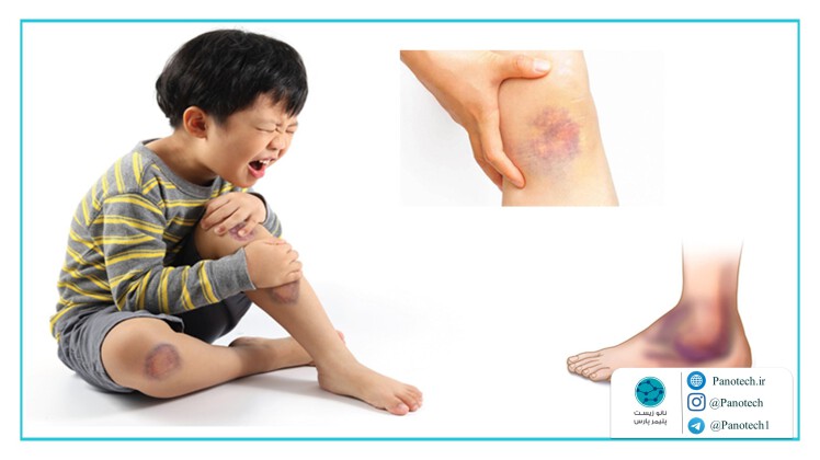 درمان زخم سطحی کودکان