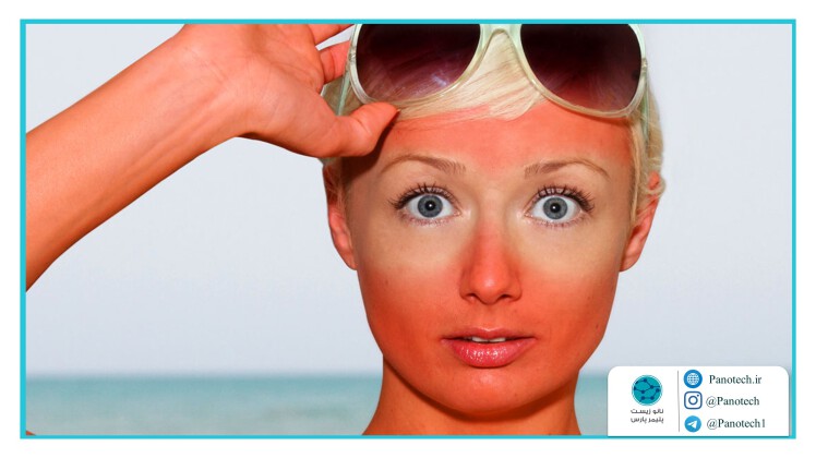آفتاب سوختگی را با 11 روش خانگی درمان کنید.