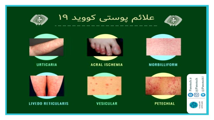 علائم پوستی ویروس کرونا را بهتر بشناسید.
